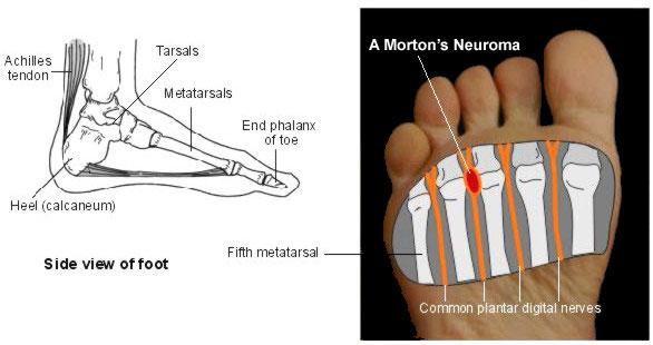 morton's neuroma