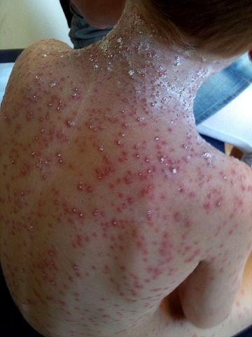 Severe chickenpox in a child
