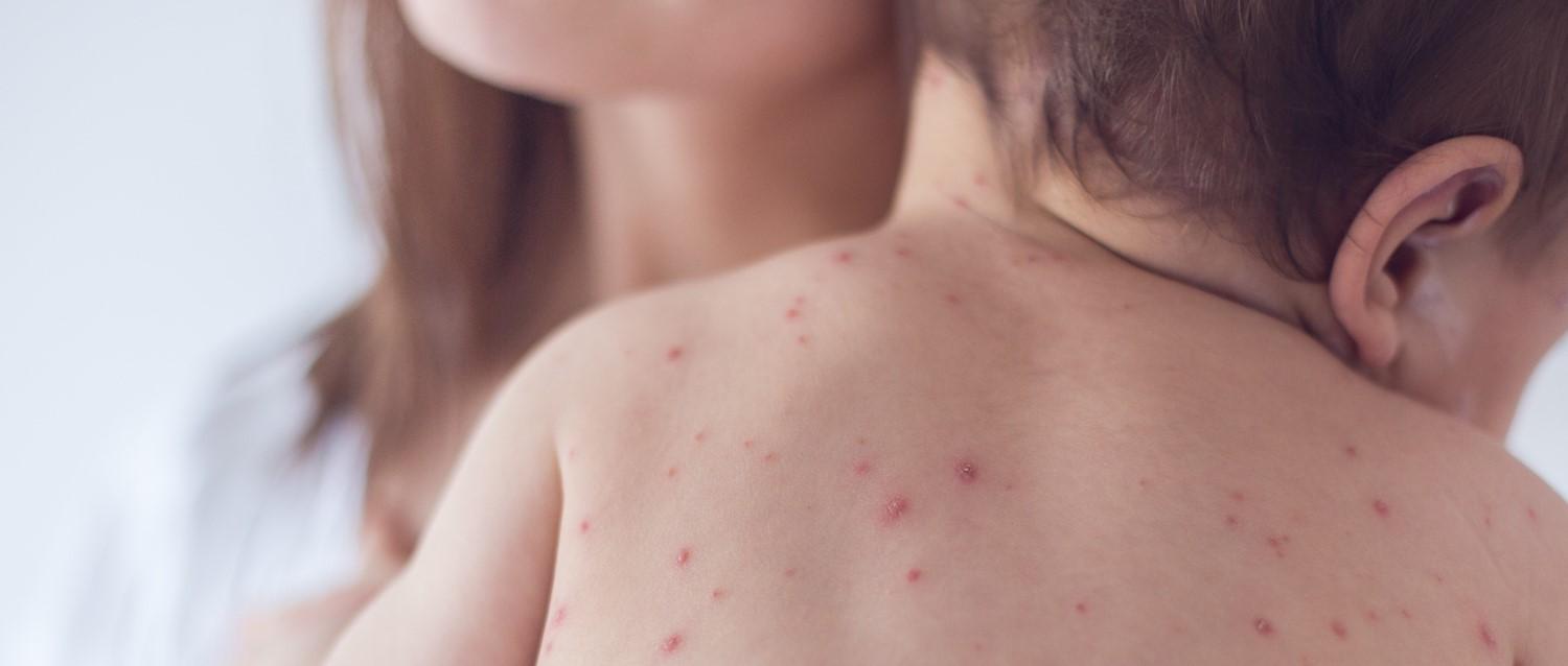 What is the difference between hand, foot and mouth disease and chickenpox