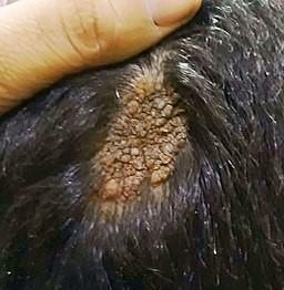 Sebaceous naevus